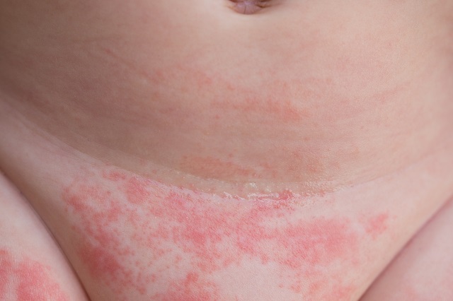 Windeldermatitis