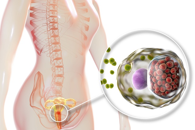 Urogenitale Chlamydien-Infektion