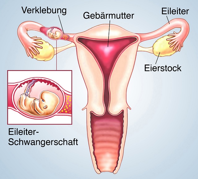 Verklebung des Eileiters