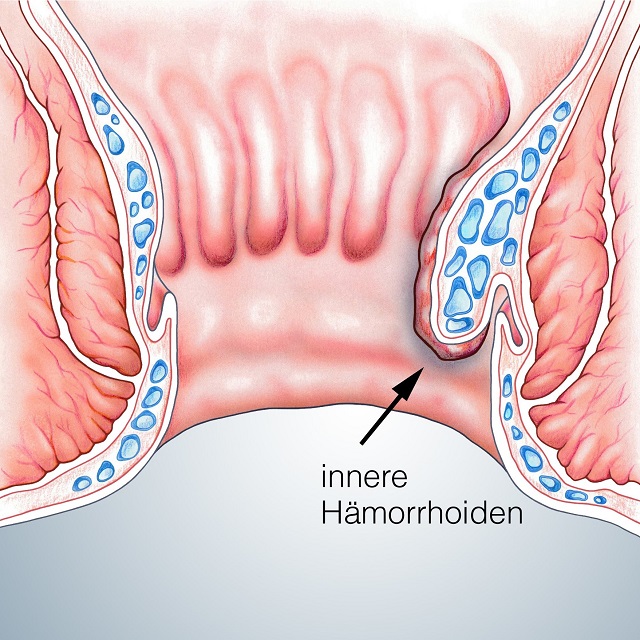 Hmorrhoiden innen